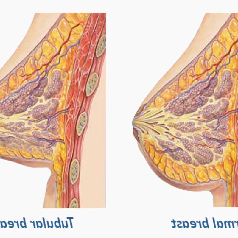 Understanding Tubular Breasts